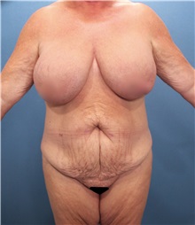 Tummy Tuck Before Photo by Marvin Shienbaum, MD; Brandon, FL - Case 30530