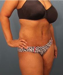 Tummy Tuck After Photo by Marvin Shienbaum, MD; Brandon, FL - Case 30531