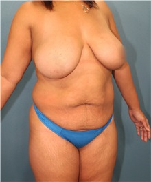 Tummy Tuck Before Photo by Marvin Shienbaum, MD; Brandon, FL - Case 30531