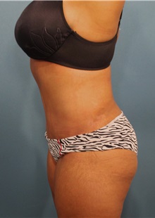 Tummy Tuck After Photo by Marvin Shienbaum, MD; Brandon, FL - Case 30531