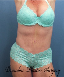 Tummy Tuck After Photo by Marvin Shienbaum, MD; Brandon, FL - Case 30532