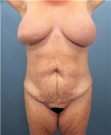 Tummy Tuck Before Photo by Marvin Shienbaum, MD; Brandon, FL - Case 30532