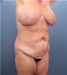 Tummy Tuck Before Photo by Marvin Shienbaum, MD; Brandon, FL - Case 30532