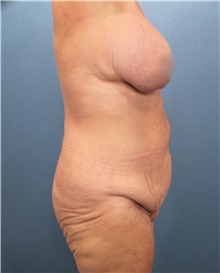 Tummy Tuck Before Photo by Marvin Shienbaum, MD; Brandon, FL - Case 30532