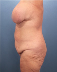 Tummy Tuck Before Photo by Marvin Shienbaum, MD; Brandon, FL - Case 30532