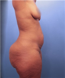 Tummy Tuck Before Photo by Marvin Shienbaum, MD; Brandon, FL - Case 30533