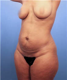 Tummy Tuck Before Photo by Marvin Shienbaum, MD; Brandon, FL - Case 30533