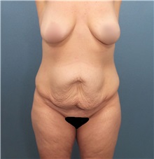 Tummy Tuck Before Photo by Marvin Shienbaum, MD; Brandon, FL - Case 30535