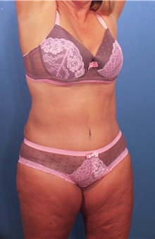 Tummy Tuck After Photo by Marvin Shienbaum, MD; Brandon, FL - Case 30540