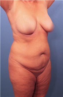 Tummy Tuck Before Photo by Marvin Shienbaum, MD; Brandon, FL - Case 30540