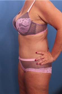 Tummy Tuck After Photo by Marvin Shienbaum, MD; Brandon, FL - Case 30540