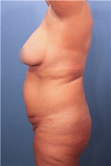 Tummy Tuck Before Photo by Marvin Shienbaum, MD; Brandon, FL - Case 30540