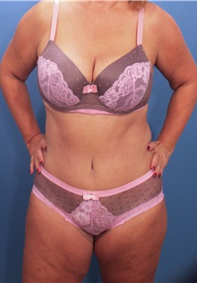 Tummy Tuck After Photo by Marvin Shienbaum, MD; Brandon, FL - Case 30540