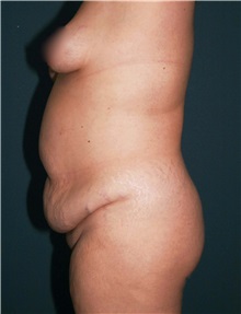 Tummy Tuck Before Photo by Marvin Shienbaum, MD; Brandon, FL - Case 30541