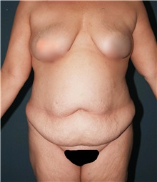 Tummy Tuck Before Photo by Marvin Shienbaum, MD; Brandon, FL - Case 30541