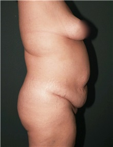 Tummy Tuck Before Photo by Marvin Shienbaum, MD; Brandon, FL - Case 30541