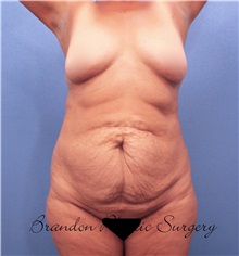 Tummy Tuck Before Photo by Marvin Shienbaum, MD; Brandon, FL - Case 30542