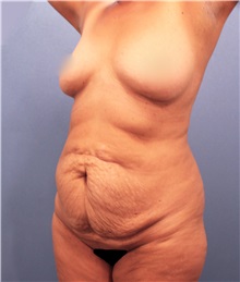 Tummy Tuck Before Photo by Marvin Shienbaum, MD; Brandon, FL - Case 30542