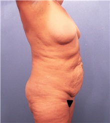 Tummy Tuck Before Photo by Marvin Shienbaum, MD; Brandon, FL - Case 30542