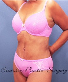 Tummy Tuck After Photo by Marvin Shienbaum, MD; Brandon, FL - Case 30542