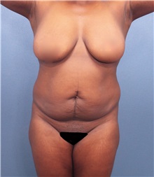 Tummy Tuck Before Photo by Marvin Shienbaum, MD; Brandon, FL - Case 30543