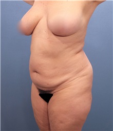 Tummy Tuck Before Photo by Marvin Shienbaum, MD; Brandon, FL - Case 30544