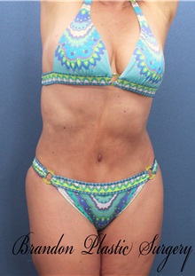 Tummy Tuck After Photo by Marvin Shienbaum, MD; Brandon, FL - Case 30544