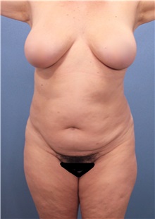 Tummy Tuck Before Photo by Marvin Shienbaum, MD; Brandon, FL - Case 30544