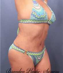 Tummy Tuck After Photo by Marvin Shienbaum, MD; Brandon, FL - Case 30544