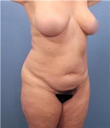 Tummy Tuck Before Photo by Marvin Shienbaum, MD; Brandon, FL - Case 30544