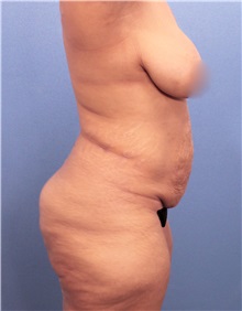 Tummy Tuck Before Photo by Marvin Shienbaum, MD; Brandon, FL - Case 30545