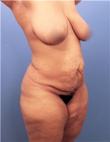 Tummy Tuck Before Photo by Marvin Shienbaum, MD; Brandon, FL - Case 30545