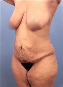 Tummy Tuck Before Photo by Marvin Shienbaum, MD; Brandon, FL - Case 30545