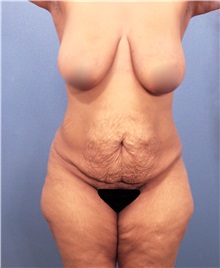 Tummy Tuck Before Photo by Marvin Shienbaum, MD; Brandon, FL - Case 30545