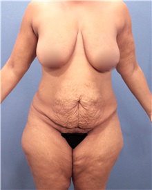 Tummy Tuck Before Photo by Marvin Shienbaum, MD; Brandon, FL - Case 30545