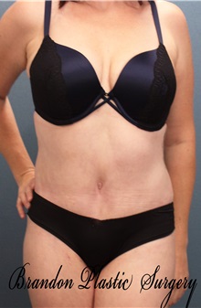 Tummy Tuck After Photo by Marvin Shienbaum, MD; Brandon, FL - Case 30546