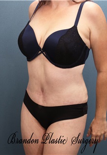 Tummy Tuck After Photo by Marvin Shienbaum, MD; Brandon, FL - Case 30546