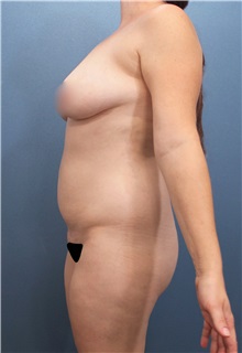 Tummy Tuck Before Photo by Marvin Shienbaum, MD; Brandon, FL - Case 30546