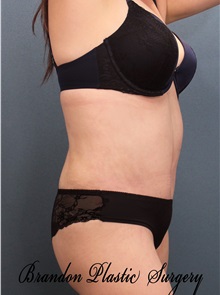 Tummy Tuck After Photo by Marvin Shienbaum, MD; Brandon, FL - Case 30546