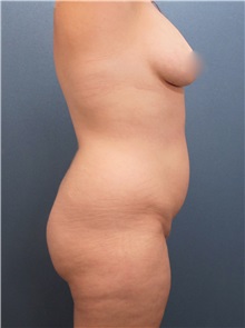 Tummy Tuck Before Photo by Marvin Shienbaum, MD; Brandon, FL - Case 30546