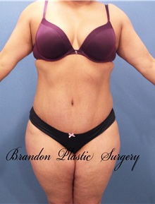 Tummy Tuck After Photo by Marvin Shienbaum, MD; Brandon, FL - Case 30547