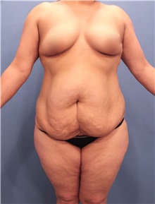 Tummy Tuck Before Photo by Marvin Shienbaum, MD; Brandon, FL - Case 30547