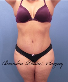 Tummy Tuck After Photo by Marvin Shienbaum, MD; Brandon, FL - Case 30547