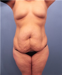 Tummy Tuck Before Photo by Marvin Shienbaum, MD; Brandon, FL - Case 30547