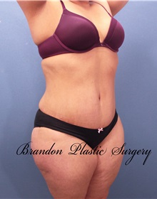 Tummy Tuck After Photo by Marvin Shienbaum, MD; Brandon, FL - Case 30547