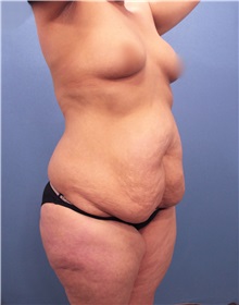 Tummy Tuck Before Photo by Marvin Shienbaum, MD; Brandon, FL - Case 30547