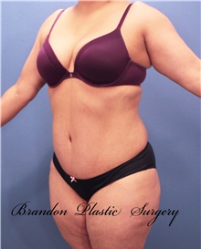 Tummy Tuck After Photo by Marvin Shienbaum, MD; Brandon, FL - Case 30547