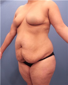 Tummy Tuck Before Photo by Marvin Shienbaum, MD; Brandon, FL - Case 30547