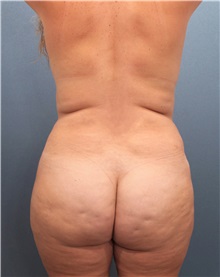 Liposuction Before Photo by Marvin Shienbaum, MD; Brandon, FL - Case 30898