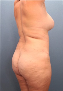 Liposuction Before Photo by Marvin Shienbaum, MD; Brandon, FL - Case 30898